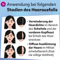 Minoxidil 20 mg / ml Spray z.Anw.a.d.Kopfhaut, 3X60 ml^Dexcel New