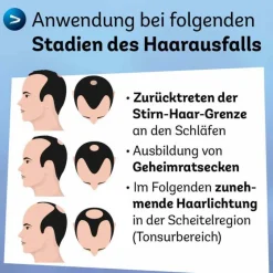 Minoxidil 50 mg / ml Spray z.Anw.a.d.Kopfhaut, 3X60 ml^Dexcel Hot