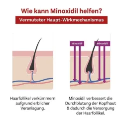 DoppelherzPharma MINOXIDIL 20 mg/ml Lösung für Frauen, 3X60 ml- Mittel Gegen Haarausfall