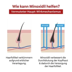 DoppelherzPharma MINOXIDIL 50 mg/ml Lösung für Männer, 3X60 ml- Mittel Gegen Haarausfall