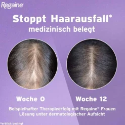 Regaine Frauen Lösung, 3X60 ml- Mittel Gegen Haarausfall