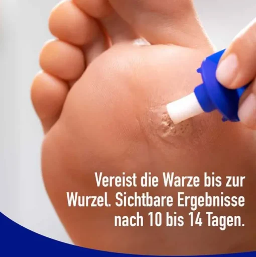 Fußwarzen Spray, 50 ml^Wartner